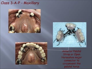 Class 3-A-P - Maxillary
Anterior Palatal
Strap or Open
Horseshoe major
connector to
circumvent the
palatal torus
 