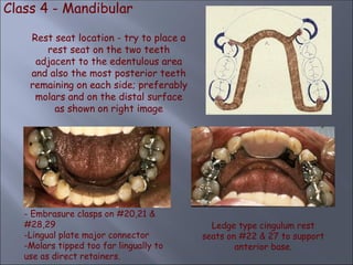 Class 4 - Mandibular
Rest seat location - try to place a
rest seat on the two teeth
adjacent to the edentulous area
and also the most posterior teeth
remaining on each side; preferably
molars and on the distal surface
as shown on right image
- Embrasure clasps on #20,21 &
#28,29
-Lingual plate major connector
-Molars tipped too far lingually to
use as direct retainers.
Ledge type cingulum rest
seats on #22 & 27 to support
anterior base.
 