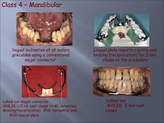 Class 4 – Mandibular
lingual inclination of all molars
preculdes using a conventional
major connector
Lingual plate imparts rigidity and
bracing (reciprocation) for I-bar
clasps on the premolars
-Labial bar major connector
-#18,32: i/2 rd. cast clasps to ML retention
-Bracing/reciprocation: #18: horizontal arm,
#32: buccal plate
-Labial bar
-#21,28: I-bar cast
clasps
 