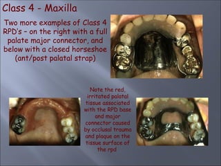 Class 4 - Maxilla
Note the red,
irritated palatal
tissue associated
with the RPD base
and major
connector caused
by occlusal trauma
and plaque on the
tissue surface of
the rpd
Two more examples of Class 4
RPD’s – on the right with a full
palate major connector, and
below with a closed horseshoe
(ant/post palatal strap)
 