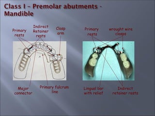 Primary fulcrum
line
Primary
rests
Indirect
Retainer
rests
Clasp
arm
Major
connector
Primary
rests
wrought wire
clasps
Indirect
retainer rests
Lingual bar
with relief
 