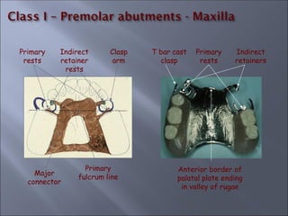 Primary
fulcrum line
Major
connector
Primary
rests
Indirect
retainer
rests
Clasp
arm
T bar cast
clasp
Primary
rests
Indirect
retainers
Anterior border of
palatal plate ending
in valley of rugae
 