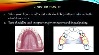 Contingency Design Rpd removable partial denture RPD design part 2 | PPTX