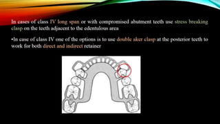 removable partial denture RPD design part 2 | PPTX