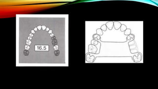 removable partial denture RPD design part 2 | PPTX