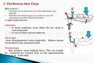 Rpd  direct retainers 2nd yr