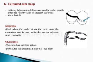 Rpd  direct retainers 2nd yr