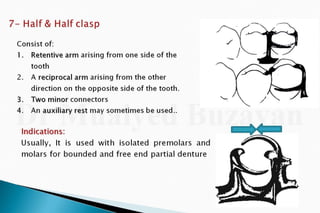 Rpd  direct retainers 2nd yr