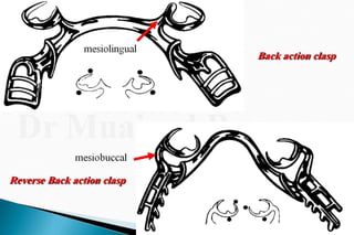 Rpd  direct retainers 2nd yr