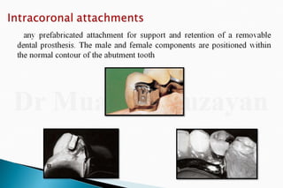 Rpd  direct retainers 2nd yr