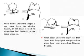 Rpd  direct retainers 2nd yr