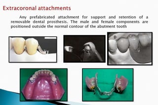 Rpd  direct retainers 2nd yr