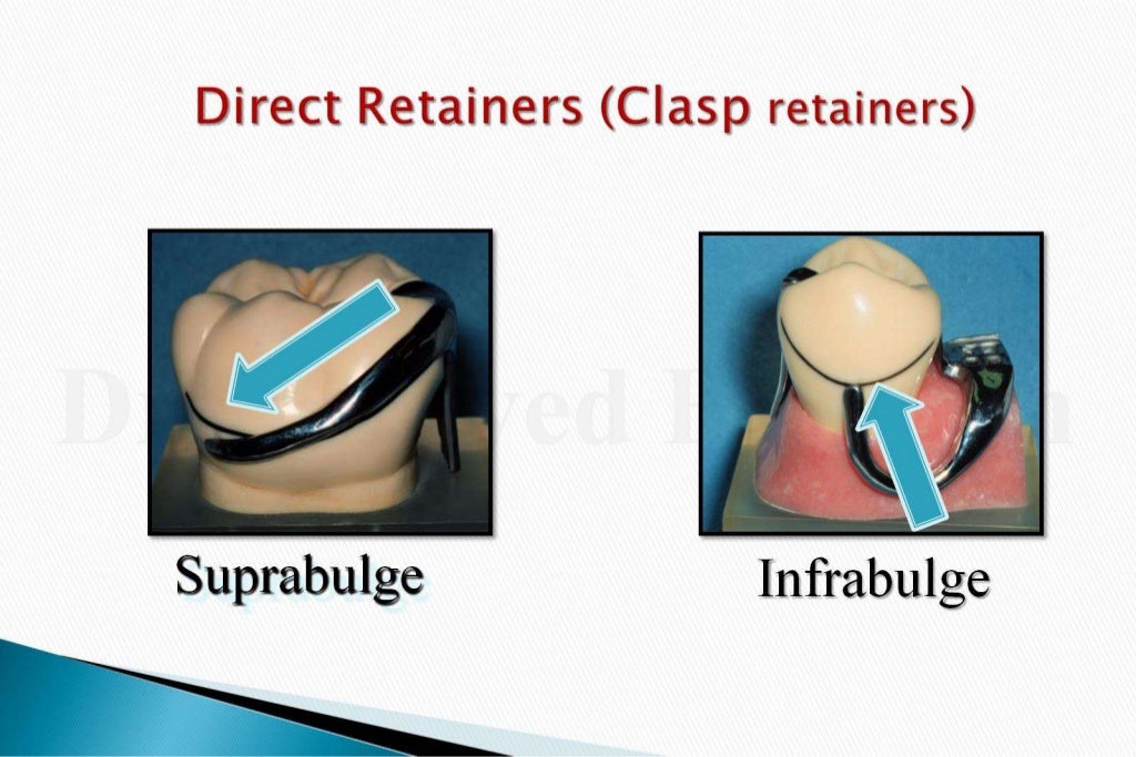 Rpd direct retainers 2nd yr