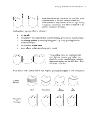 Surveying, Path of Insertion, Guiding Planes - 19
When the retentive arm (•) contacts the tooth first, it can
cause movement of the tooth since the tooth is not
stabilized to resist displacement. When the rigid bracing
or reciprocal arm contacts first, it braces the tooth so the
retentive arm cannot displace it.
Guiding planes are most effective when they:
a. are parallel
b. include more than one common axial surface (e.g. proximal and lingual surfaces)
c. are directly opposed by another guiding plane (e.g. facing guiding planes in a
modification space)
d. are placed on several teeth
e. cover a large surface area (long and/or broad)
These guiding planes are parallel, include
more than one common axial surface (i.e.
distal of premolar, mesial of molar), directly
oppose one another and are fairly long. They
will be very effective.
When marked with a carbon marker, well-prepared guiding planes appear as wide survey lines:
 