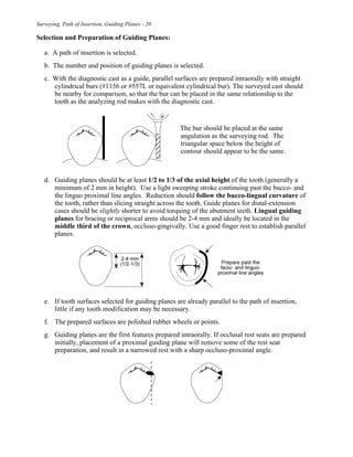 Surveying, Path of Insertion, Guiding Planes - 20
Selection and Preparation of Guiding Planes:
a. A path of insertion is selected.
b. The number and position of guiding planes is selected.
c. With the diagnostic cast as a guide, parallel surfaces are prepared intraorally with straight
cylindrical burs (#1156 or #557L or equivalent cylindrical bur). The surveyed cast should
be nearby for comparison, so that the bur can be placed in the same relationship to the
tooth as the analyzing rod makes with the diagnostic cast.
The bur should be placed at the same
angulation as the surveying rod. The
triangular space below the height of
contour should appear to be the same.
d. Guiding planes should be at least 1/2 to 1/3 of the axial height of the tooth (generally a
minimum of 2 mm in height). Use a light sweeping stroke continuing past the bucco- and
the linguo proximal line angles. Reduction should follow the bucco-lingual curvature of
the tooth, rather than slicing straight across the tooth. Guide planes for distal-extension
cases should be slightly shorter to avoid torquing of the abutment teeth. Lingual guiding
planes for bracing or reciprocal arms should be 2-4 mm and ideally be located in the
middle third of the crown, occluso-gingivally. Use a good finger rest to establish parallel
planes.
e. If tooth surfaces selected for guiding planes are already parallel to the path of insertion,
little if any tooth modification may be necessary.
f. The prepared surfaces are polished rubber wheels or points.
g. Guiding planes are the first features prepared intraorally. If occlusal rest seats are prepared
initially, placement of a proximal guiding plane will remove some of the rest seat
preparation, and result in a narrowed rest with a sharp occluso-proximal angle.
 
