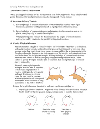 Surveying, Path of Insertion, Guiding Planes - 22
Alteration of Other Axial Contours
While guiding plane surfaces are the most common axial tooth preparations made for removable
partial dentures, other axial preparations may also be required. These include:
A. Lowering Height of Contours
1. Lowering height of contours to eliminate tooth interferences in areas where rigid
frameworks elements will be placed (such as rigid portions of retentive arms).
2. Lowering height of contours to improve esthetics (e.g. to allow retentive arms to be
placed more gingivally to reduce clasp display).
When preparing axial contours for these situations, the heights of contour are most
quickly lowered by placing the bur parallel to the path of insertion.
B. Raising Height of Contours
The only time that a height of contour would be raised would be when there is no retentive
undercut present or when the undercut is so far gingival that the retentive tip would either
impinge on the free gingival margin or cause a hygiene problem due to its proximity to the
free gingival margin. In general, the inferior portion of the retentive undercut should be at
least 1mm above the free gingival margin. Raising the height of contour is only feasible
when the axial surface is parallel or slightly divergent to the path of insertion. If the
surface is grossly divergent from the path of insertion, then raising the height of contour
may be impossible.
The tooth on the right is grossly
divergent from the path of insertion,
so that excessive preparation is
required just to gain the appropriate
undercut. Dentin, or in extreme
cases, the pulp could be exposed.
Minimal preparation will be required
on the tooth on the left since its long
axis is close to the path of insertion.
Raising the height of contour for retentive undercuts can be accomplished by:
1. Preparing a retentive undercut. Prepare an ovoid undercut with the inferior border at
least 1 mm from the free gingival margin, using a round or chamfer diamond bur.
Correct Should be more Too close to
ovoid, like clasp free gingival
tip margin
 