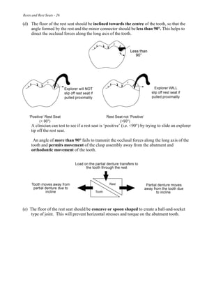 Rests and Rest Seats - 26
(d) The floor of the rest seat should be inclined towards the centre of the tooth, so that the
angle formed by the rest and the minor connector should be less than 90°. This helps to
direct the occlusal forces along the long axis of the tooth.
A clinician can test to see if a rest seat is ‘positive’ (i.e. <90°) by trying to slide an explorer
tip off the rest seat.
An angle of more than 90° fails to transmit the occlusal forces along the long axis of the
tooth and permits movement of the clasp assembly away from the abutment and
orthodontic movement of the tooth.
(e) The floor of the rest seat should be concave or spoon shaped to create a ball-and-socket
type of joint. This will prevent horizontal stresses and torque on the abutment tooth.
 