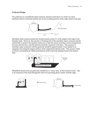 Minor Connectors - 41
Gridwork Design
The gridwork on a mandibular distal extension should extend about 2/3 of the way from
abutment tooth to retromolar pad but not on the ascending portion of the ridge mesial to the pad.
Maxillary distal extension gridworks should extend at least 2/3 of the length of the ridge to the
hamular notch. However, the junction or finishing line of the maxillary major connector should
extend fully to point to the hamular notch area so that the acrylic resin base can be extended into
this area and provide a smooth transition from the connector to the base. The junction of
maxillary major connector with the gridwork should be approximately 2 mm medial to an
imaginary line along the lingual surfaces of the replacement denture teeth. This ensures a bulk
of acrylic surrounding the replacement denture teeth to provide adequate bond to the denture
base.
Mandibular distal extension gridworks should have a “tissue stop” at their posterior limit. This
is an extension of the metal through the relief wax providing direct contact with the ridge.
 