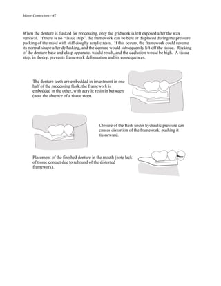 Minor Connectors - 42
When the denture is flasked for processing, only the gridwork is left exposed after the wax
removal. If there is no “tissue stop”, the framework can be bent or displaced during the pressure
packing of the mold with stiff doughy acrylic resin. If this occurs, the framework could resume
its normal shape after deflasking, and the denture would subsequently lift off the tissue. Rocking
of the denture base and clasp apparatus would result, and the occlusion would be high. A tissue
stop, in theory, prevents framework deformation and its consequences.
The denture teeth are embedded in investment in one
half of the processing flask, the framework is
embedded in the other, with acrylic resin in between
(note the absence of a tissue stop).
Closure of the flask under hydraulic pressure can
causes distortion of the framework, pushing it
tissueward.
Placement of the finished denture in the mouth (note lack
of tissue contact due to rebound of the distorted
framework).
 
