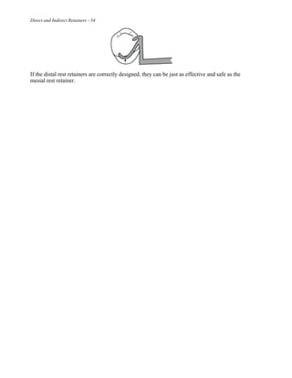 Direct and Indirect Retainers - 54
If the distal rest retainers are correctly designed, they can be just as effective and safe as the
mesial rest retainer.
 