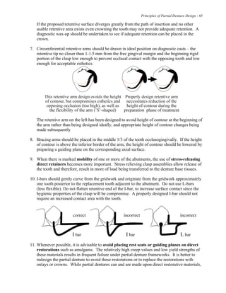 Principles of Partial Denture Design - 65
If the proposed retentive surface diverges greatly from the path of insertion and no other
usable retentive area exists even crowning the tooth may not provide adequate retention. A
diagnostic wax-up should be undertaken to see if adequate retention can be placed in the
crown.
7. Circumferential retentive arms should be drawn in ideal position on diagnostic casts – the
retentive tip no closer than 1-1.5 mm from the free gingival margin and the beginning rigid
portion of the clasp low enough to prevent occlusal contact with the opposing tooth and low
enough for acceptable esthetics.
The retentive arm on the left has been designed to avoid height of contour at the beginning of
the arm rather than being designed ideally, and appropriate height of contour changes being
made subsequently
8. Bracing arms should be placed in the middle 1/3 of the tooth occlusogingivally. If the height
of contour is above the inferior border of the arm, the height of contour should be lowered by
preparing a guiding plane on the corresponding axial surface.
9. When there is marked mobility of one or more of the abutments, the use of stress-releasing
direct retainers becomes more important. Stress relieving clasp assemblies allow release of
the tooth and therefore, result in more of load being transferred to the denture base tissues.
10. I-bars should gently curve from the gridwork and originate from the gridwork approximately
one tooth posterior to the replacement tooth adjacent to the abutment. Do not use L-bars
(less flexible). Do not flatten retentive end of the I-bar, to increase surface contact since the
hygienic properties of the clasp will be compromise. A properly designed I-bar should not
require an increased contact area with the tooth.
11. Whenever possible, it is advisable to avoid placing rest seats or guiding planes on direct
restorations such as amalgams. The relatively high creep values and low yield strengths of
these materials results in frequent failure under partial denture frameworks. It is better to
redesign the partial denture to avoid these restorations or to replace the restorations with
onlays or crowns. While partial dentures can and are made upon direct restorative materials,
 