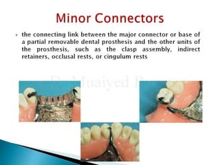 Rest Connector Rpd Rpd minor connectors 2nd yr | PPTX