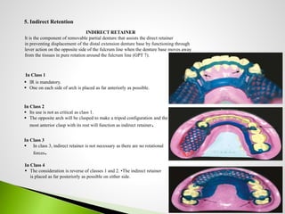 Direct Retainer In Rpd RPD DESIGN | PPTX
