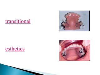 Rpd removable partial denture introduction 2nd yr | PPTX