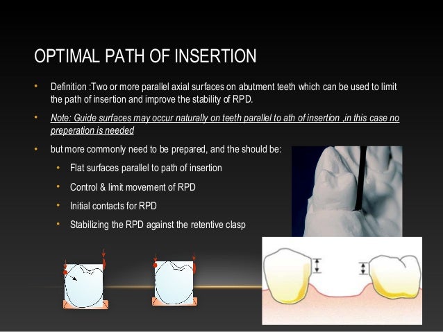 insertion path denture abutment