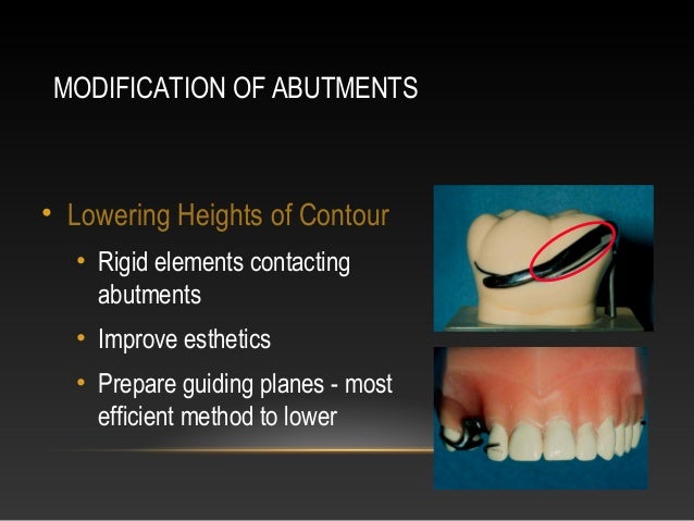removable partial denture survey lines path of removable partial denture design