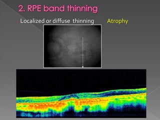RPE changes in OCT | PPTX