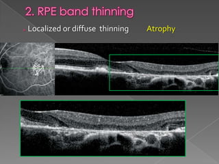 RPE changes in OCT | PPTX