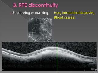 RPE changes in OCT | PPTX