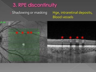RPE changes in OCT | PPTX