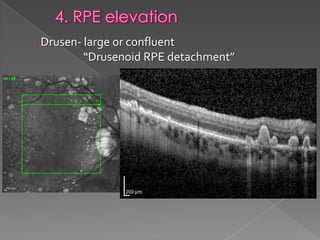 RPE changes in OCT | PPTX