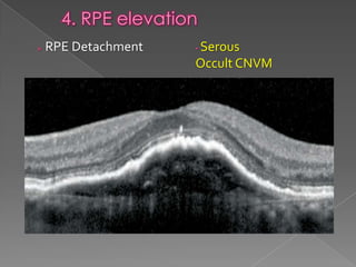 RPE changes in OCT | PPTX