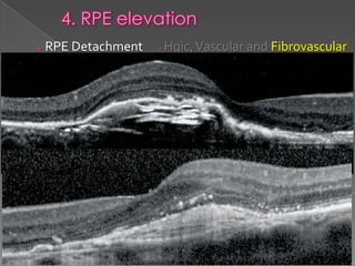 RPE changes in OCT | PPTX