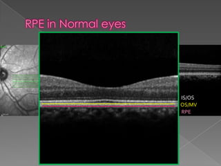 RPE changes in OCT | PPTX
