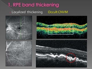 RPE changes in OCT | PPTX