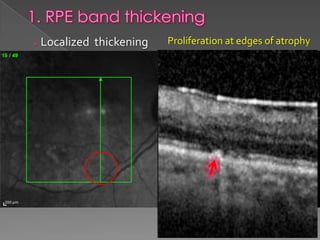 RPE changes in OCT | PPTX