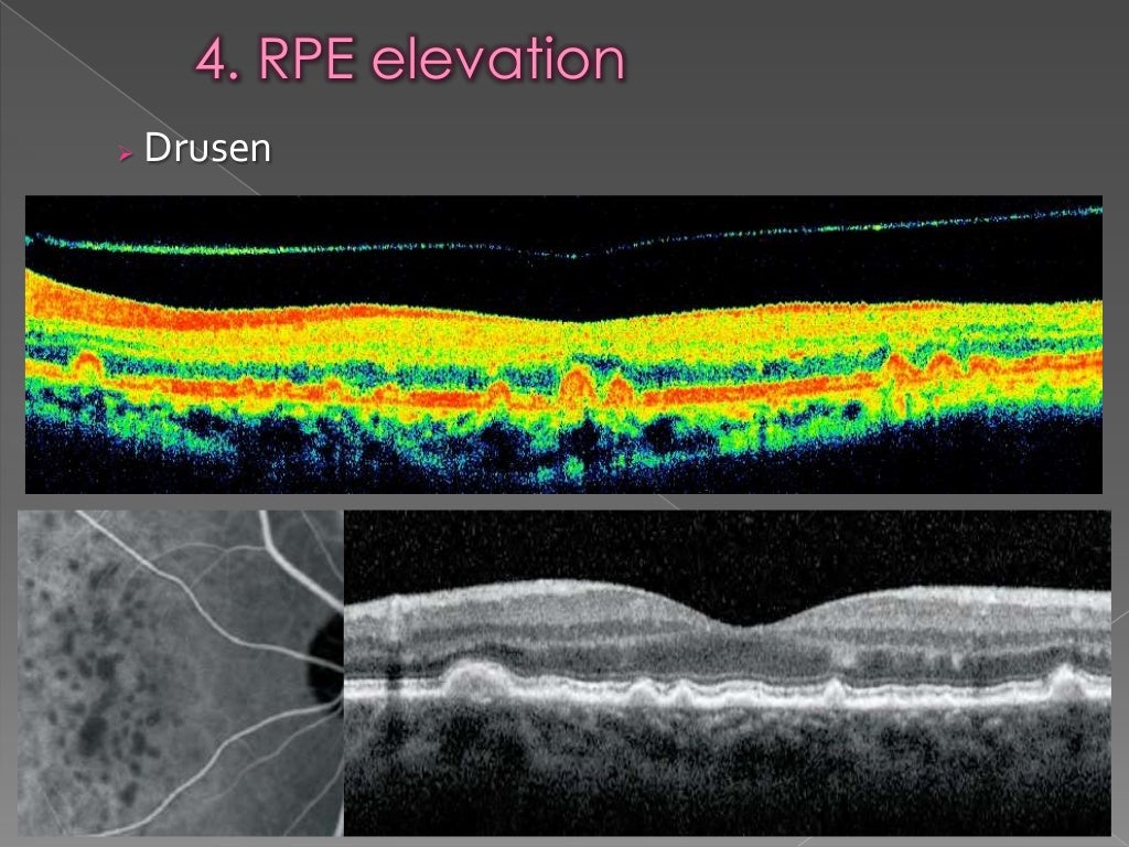 RPE changes in OCT