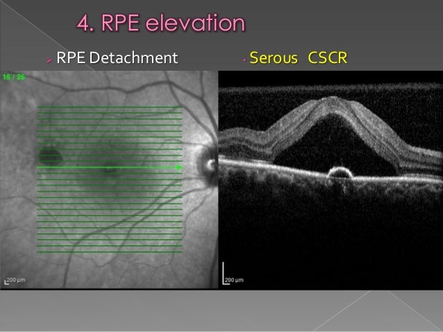 RPE changes in OCT