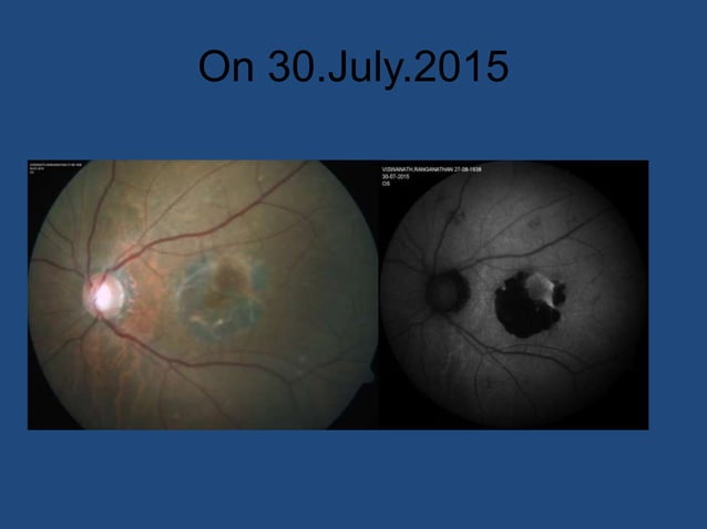 RPE Tear,,,,Retinal Pigment Epithelium Tear.pptx
