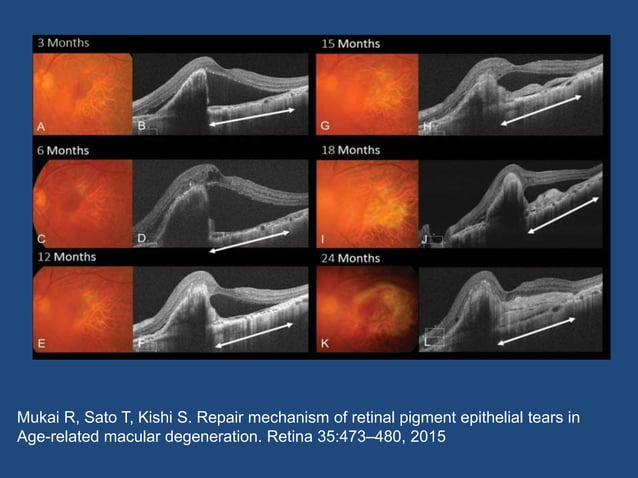 RPE Tear,,,,Retinal Pigment Epithelium Tear.pptx