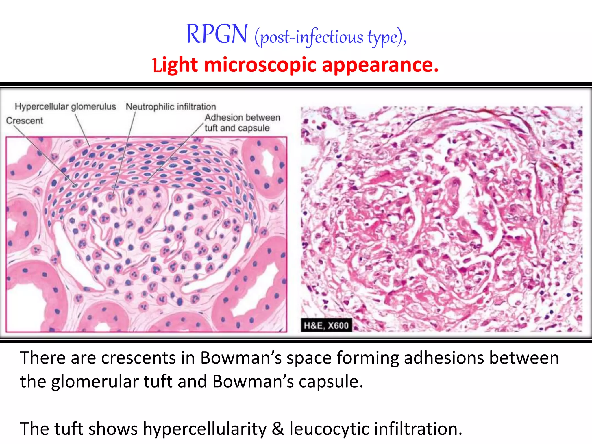 The KIDNEY: Rapidly Progressive Glomerulonephritis | PPTX