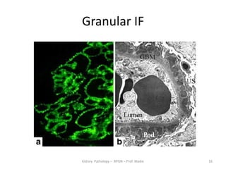 Rpgn Patterns Rpgn renal pathology- prof wadie | PDF