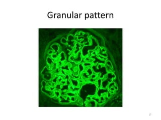 Rpgn Patterns Rpgn renal pathology- prof wadie | PDF