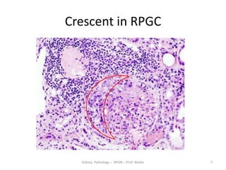 Rpgn Patterns Rpgn renal pathology- prof wadie | PDF
