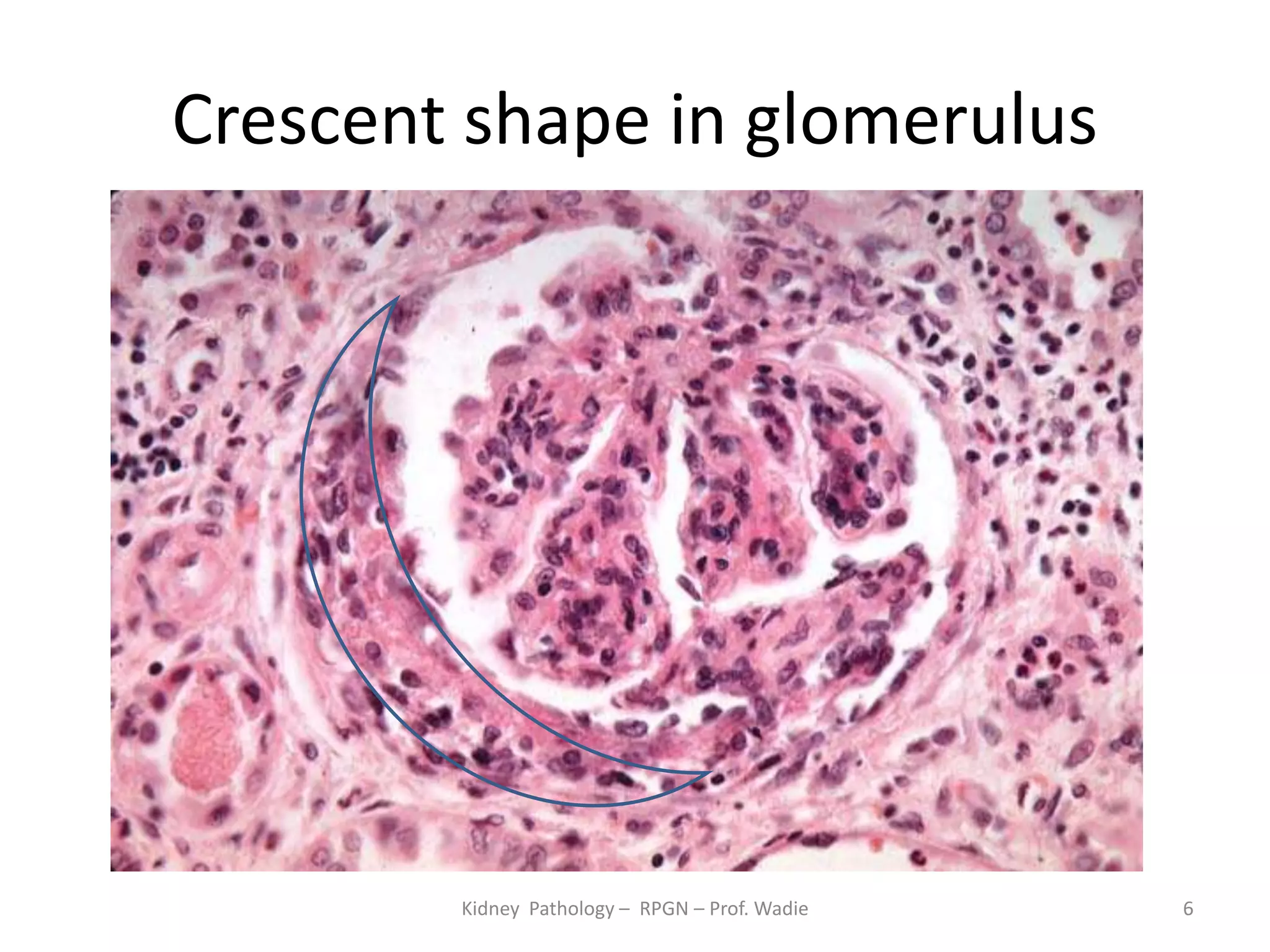 Crescentic Rpgn Rapidly Progressive Glomerulonephritis - renal pathology- prof wadie | PPTX