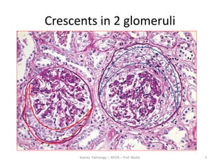 Crescentic Rpgn Rapidly Progressive Glomerulonephritis - renal pathology- prof wadie | PPTX